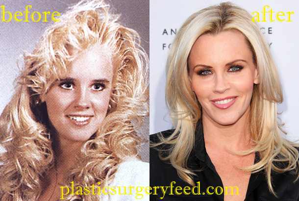 Jenny McCarthy Botox