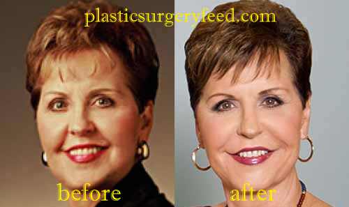 Joyce Meyer Facelift