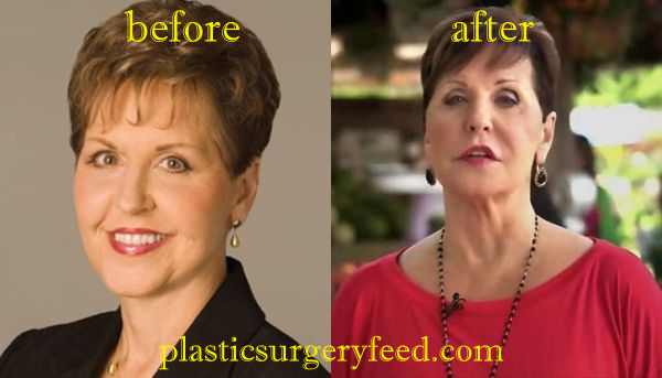 joyce meyer lips surgery