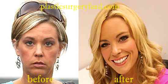 Kate Gosselin Botox and Facelift