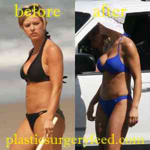 Kate Gosselin Breast Implants