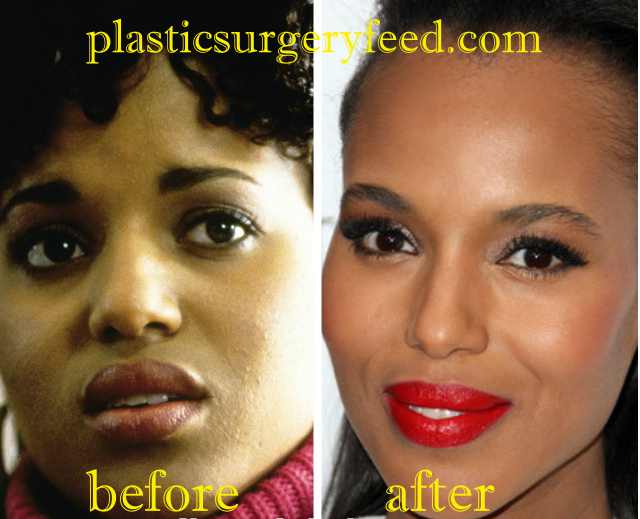 Kerry Washington Cheek Implant