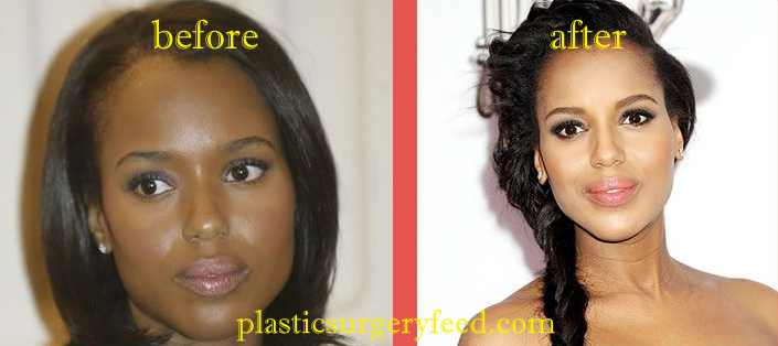 Kerry Washington Nose Job