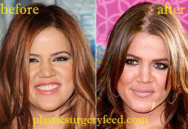 Khloe Kardashian Lip Filler and Facelift
