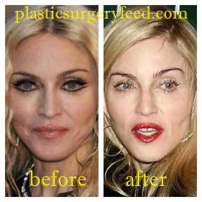 Madonna Lips Implant
