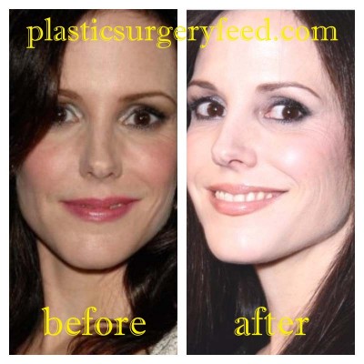 Mary Louise Parker Botox and Facelift