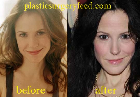 Mary Louise Parker Nose Job