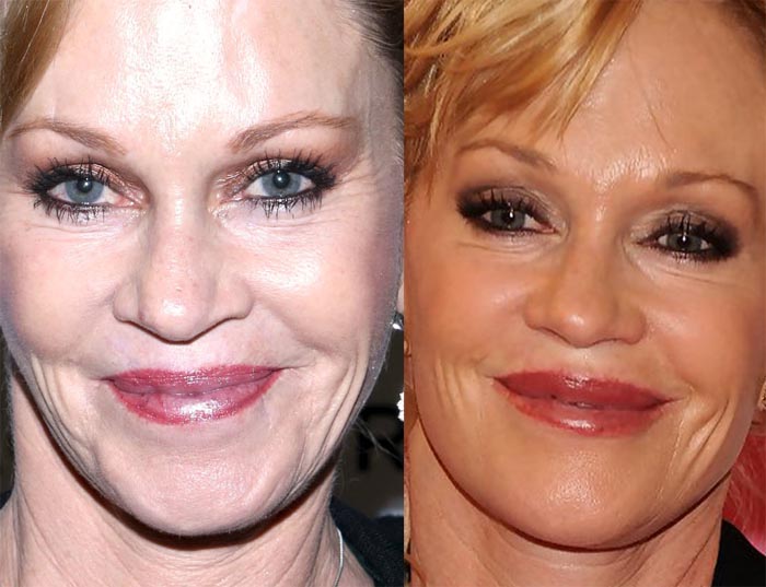 Melanie Griffith Lip Augmentation