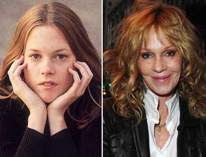 Melanie Griffith Lips Surgery