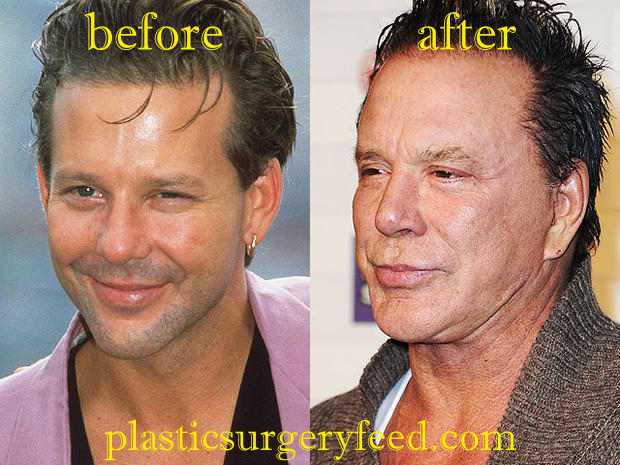 Mickey Rourke Cheek Augmentation