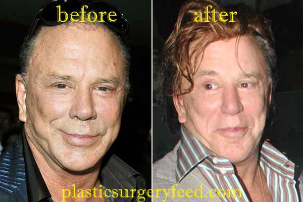 Mickey Rourke Facelift