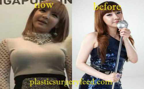 Park Bom Breast Implant