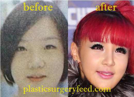 Park Bom Nose Job