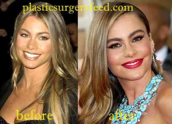 Sofia Vergara Facelift