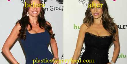 Sofia Vergara Liposuction