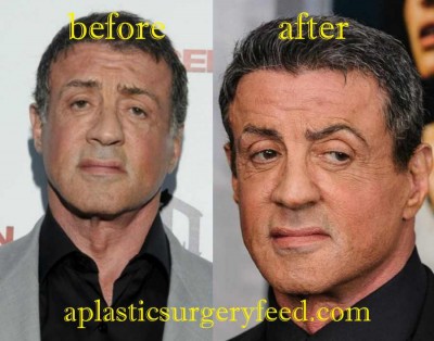 Sylvester Stallone Botox
