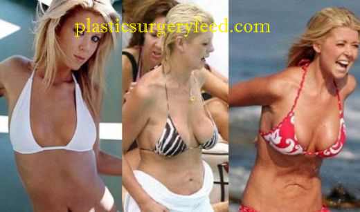 Tara Reid Liposuction