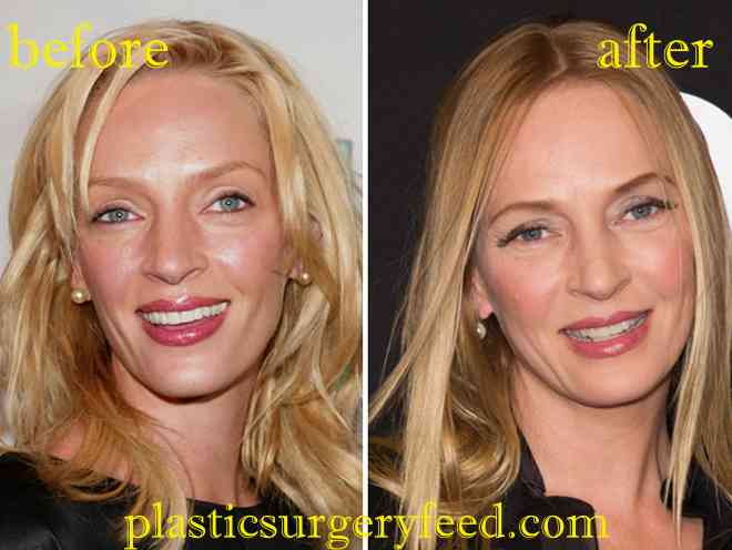 Uma Thurman Botox and Facelift