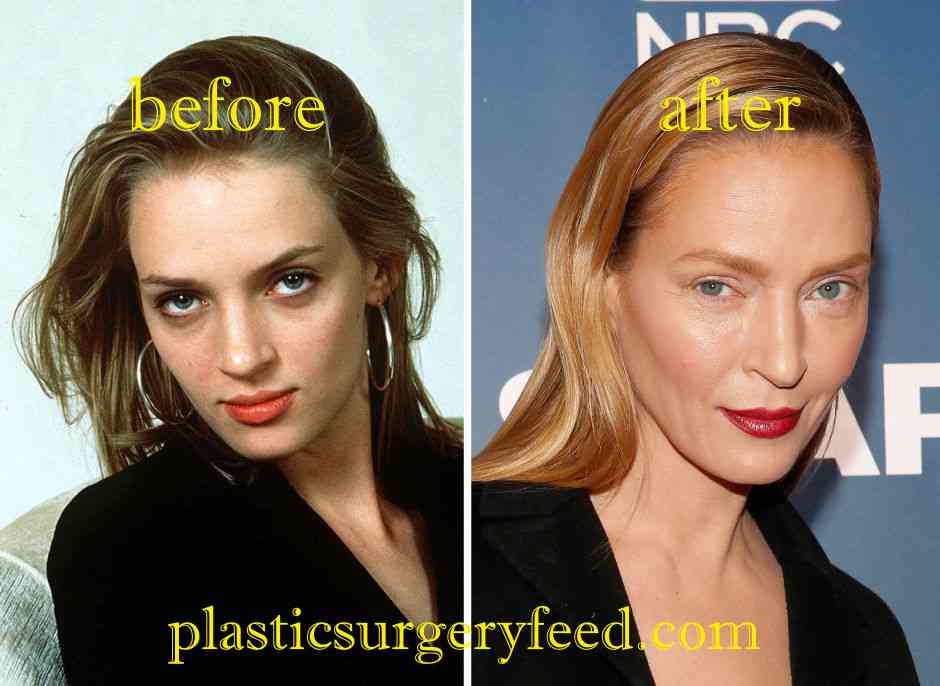 Uma Thurman Cheek Implants