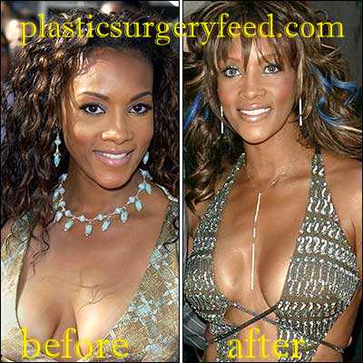 Vivica Fox Breast Implants