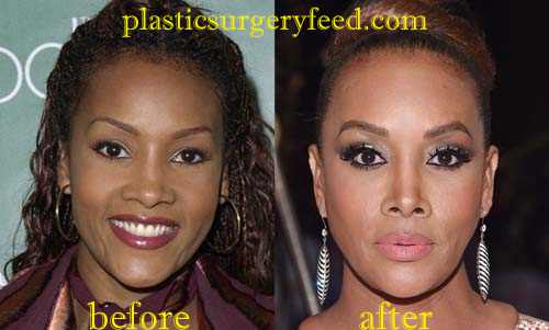 Vivica Fox Nose Job