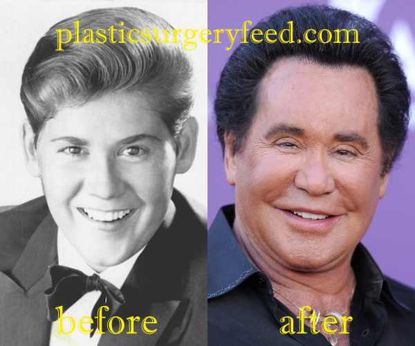 Wayne Newton Facelift