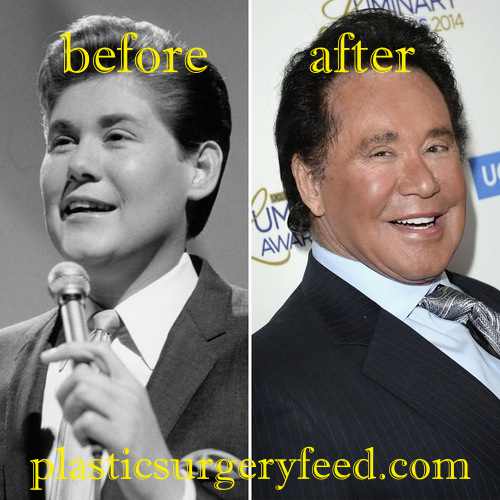 Wayne Newton Nose Job