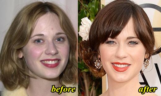 Zooey Deschanel Lip Implant