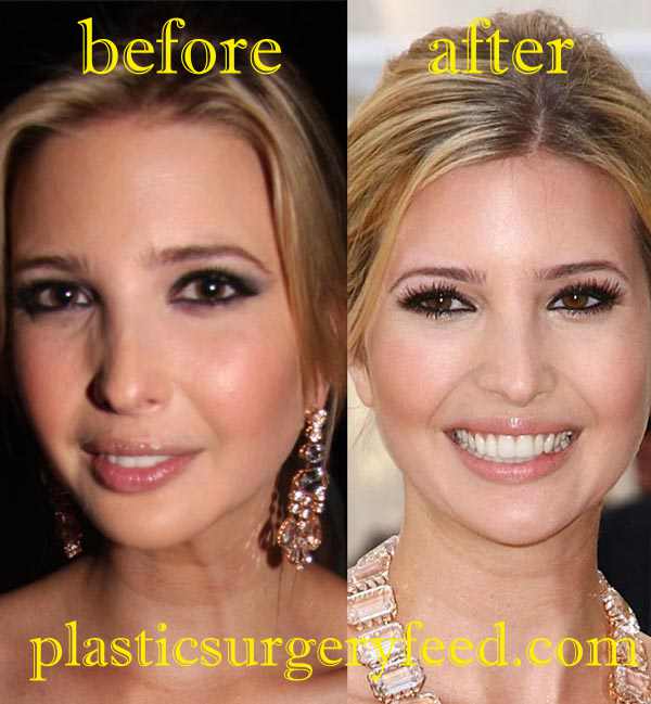 Ivanka Trump Botox