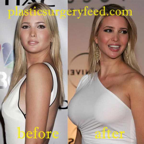 Ivanka Trump Breast Implant