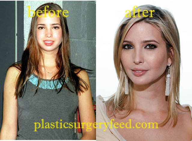 Ivanka Trump Lip ENhancement