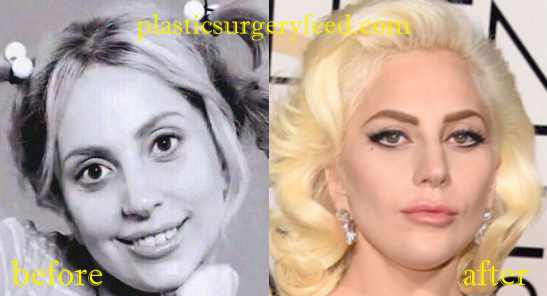 Lady Gaga Nose Job