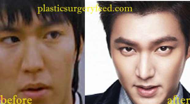 Lee Min Ho Lip Enhancement