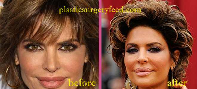 Lisa Rinna Botox