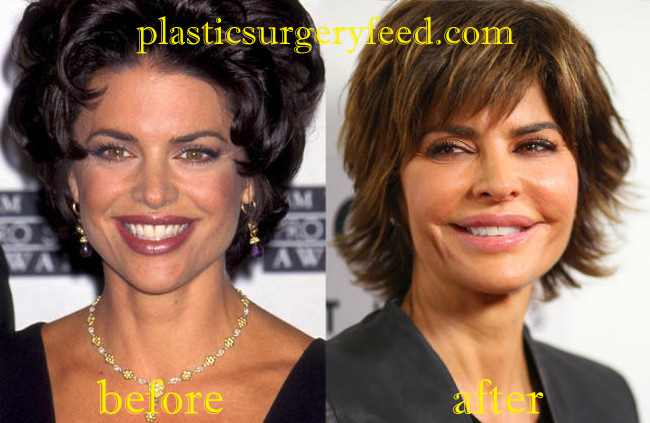 Lisa Rinna Lip Enhancement