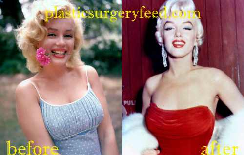 Marilyn Monroe Breast Implant