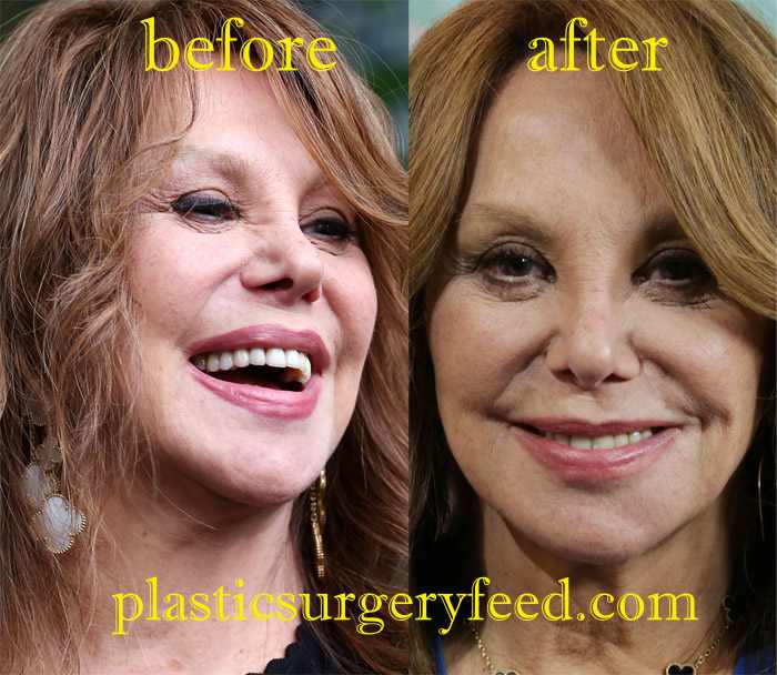 Marlo Thomas Botox