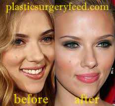 Scarlett Johansson Nose Job