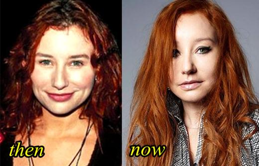 Tori Amos Botox