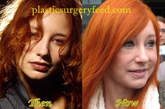 Tori Amos Brow Lift