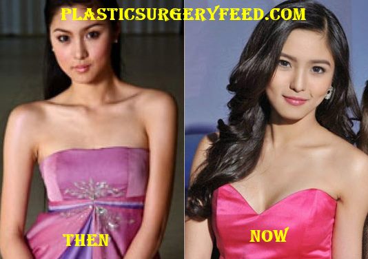 Kim Chiu Plastic Surgery Plastic Surgery Feed