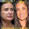 Demi Moore Botox Surgery