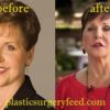 Joyce Meyer Lip Injection